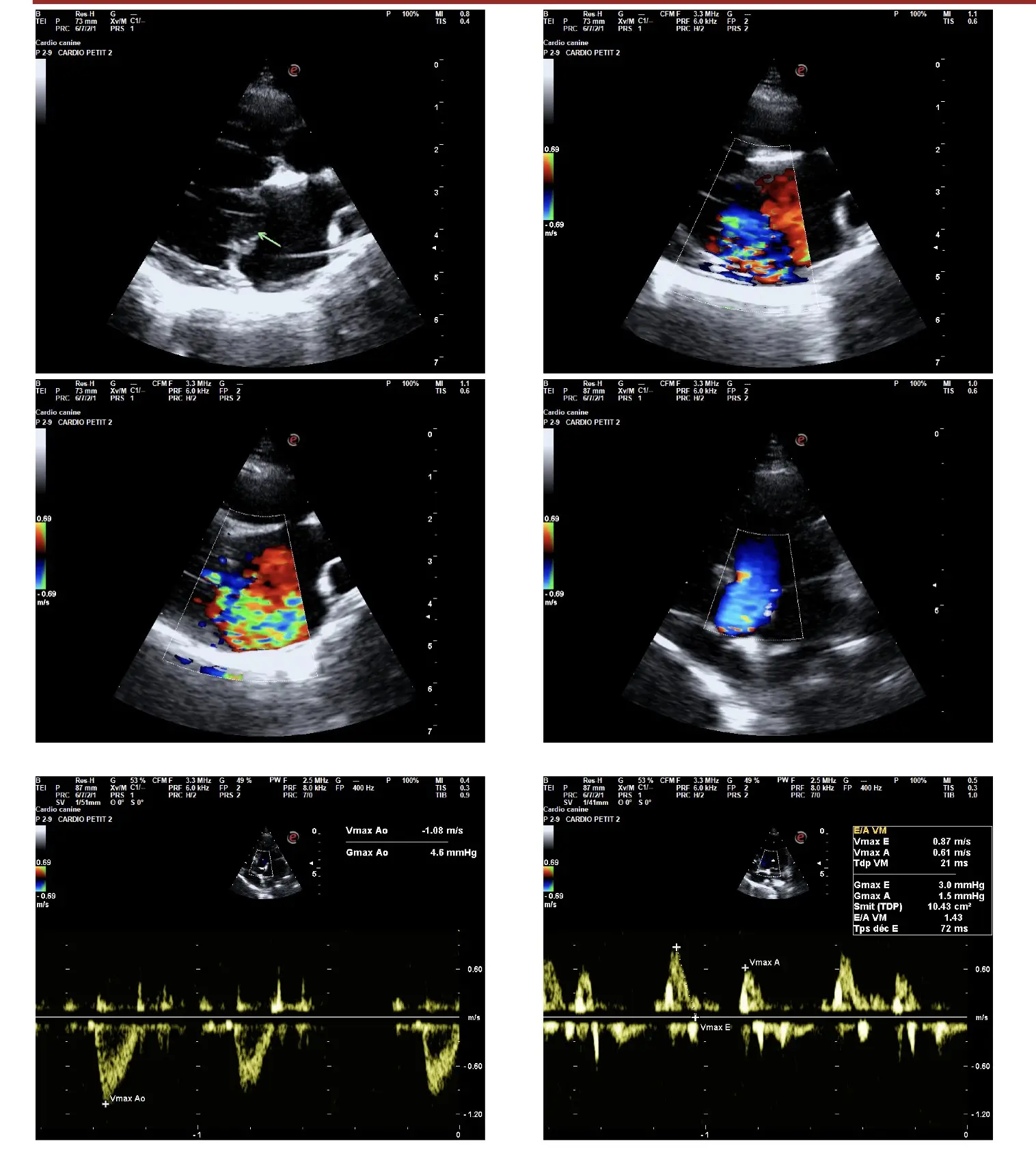 Planche de six images échographiques annotées, avec mesures Doppler, jointes au compte rendu